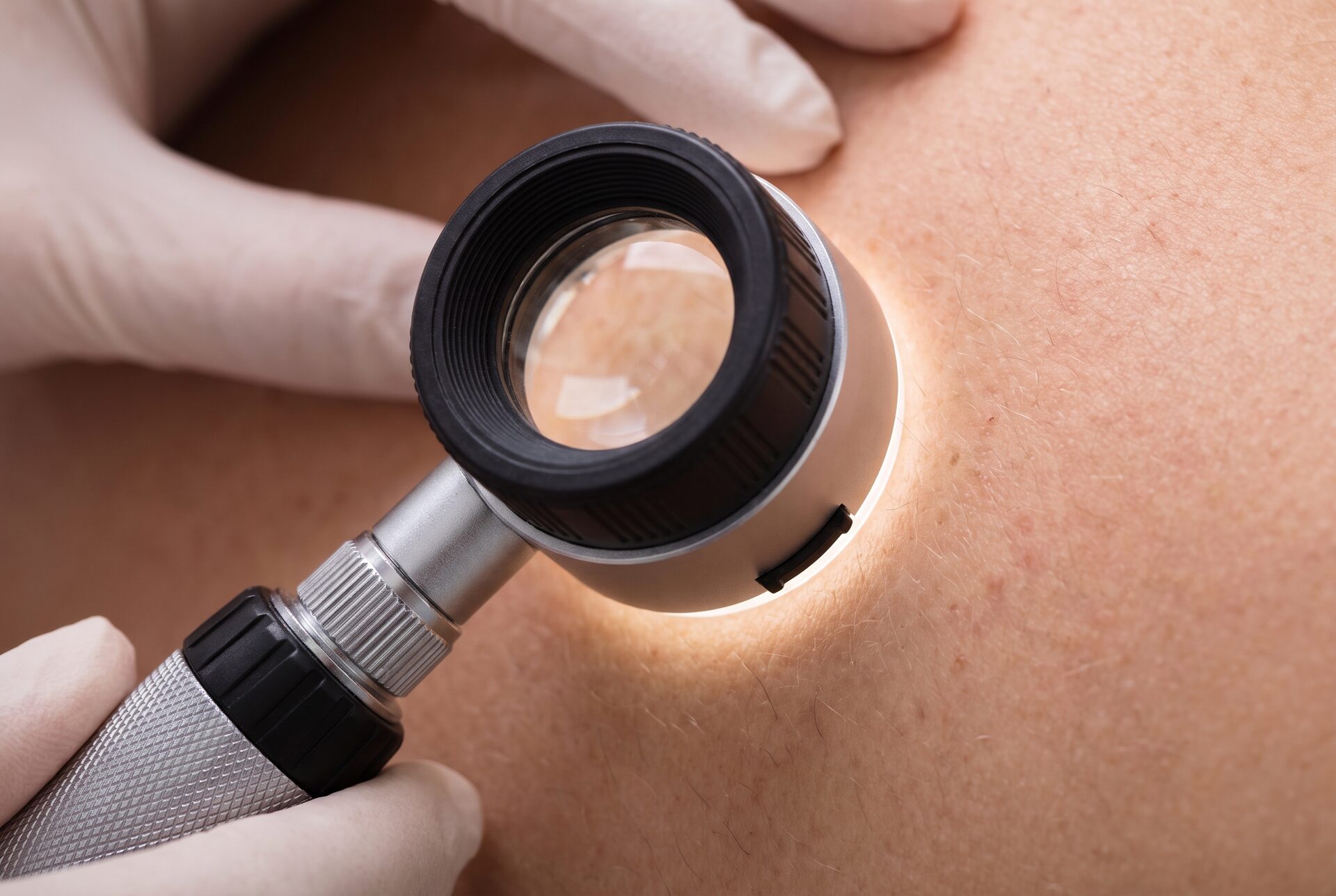 Nahaufnahme eines Dermatoskops bei der Untersuchung der Hautstruktur